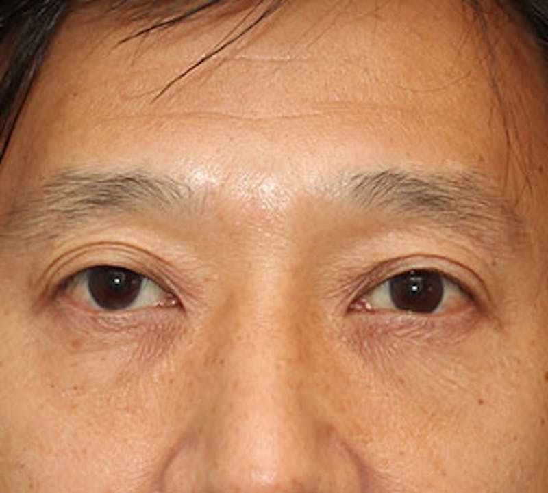 Blepharoplasty Before & After Gallery - Patient 12737125 - Image 2