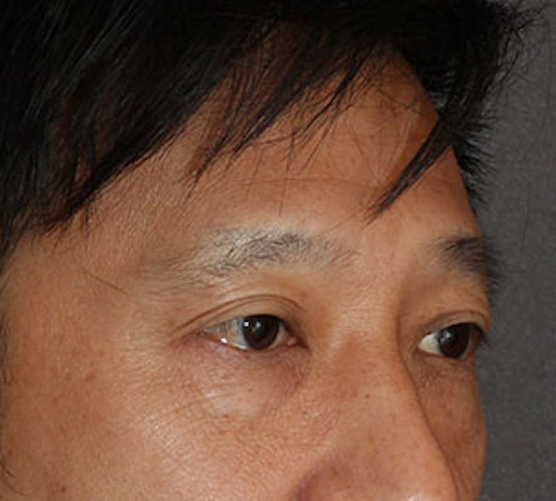 Blepharoplasty Before & After Gallery - Patient 12737125 - Image 3