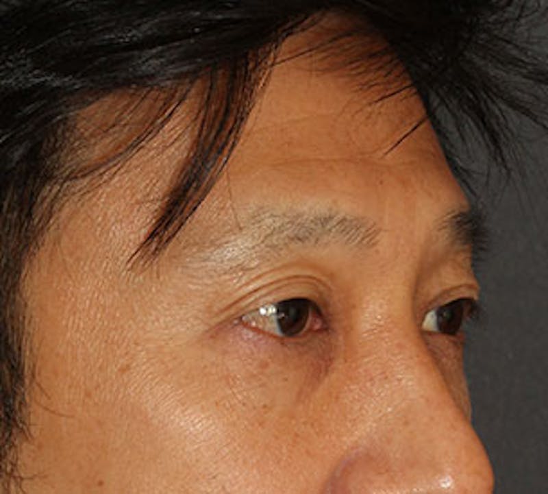 Blepharoplasty Before & After Gallery - Patient 12737125 - Image 4