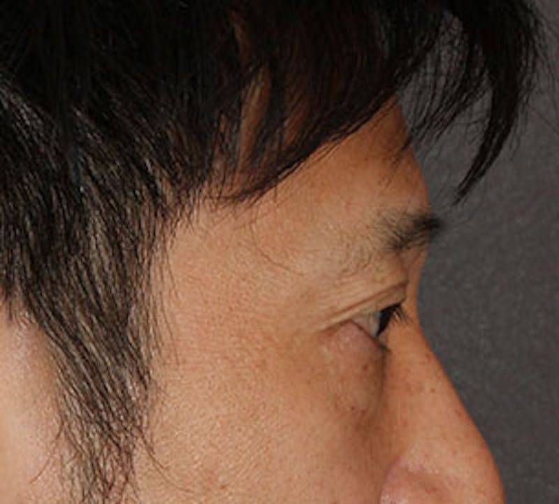 Blepharoplasty Before & After Gallery - Patient 12737125 - Image 5