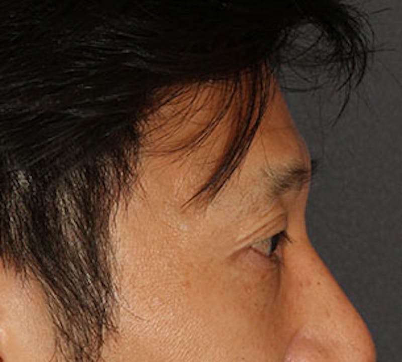 Blepharoplasty Before & After Gallery - Patient 12737125 - Image 6