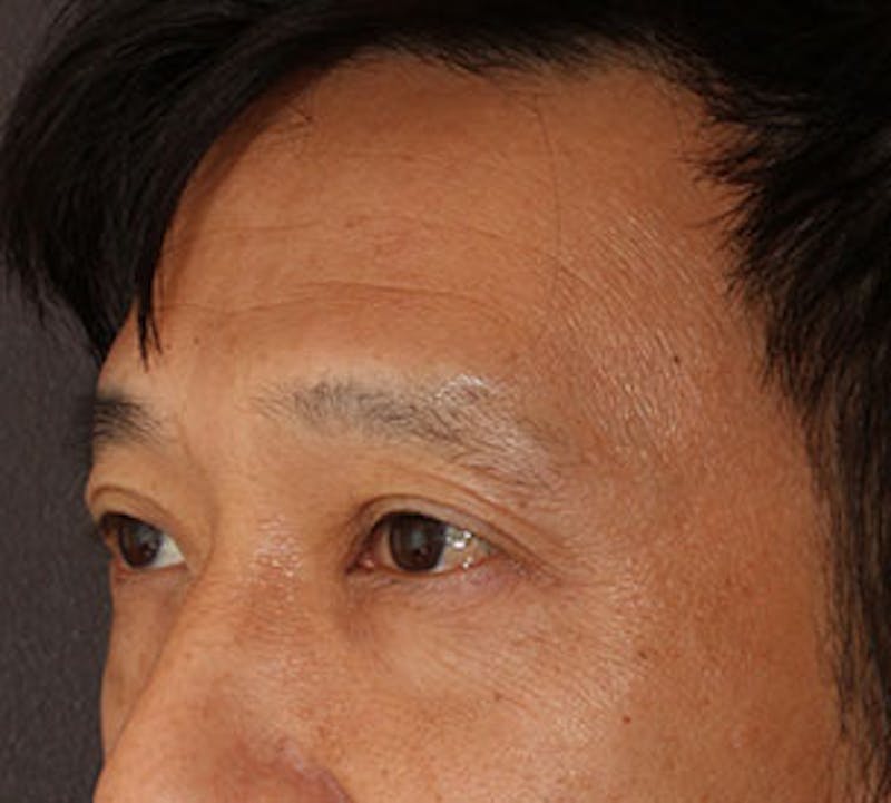 Blepharoplasty Before & After Gallery - Patient 12737125 - Image 7