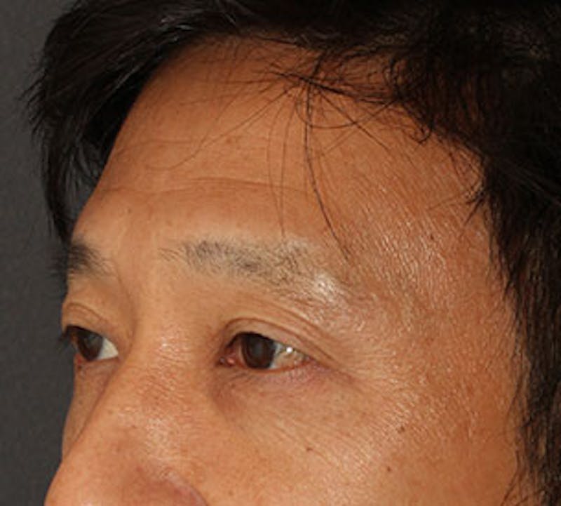 Blepharoplasty Before & After Gallery - Patient 12737125 - Image 8