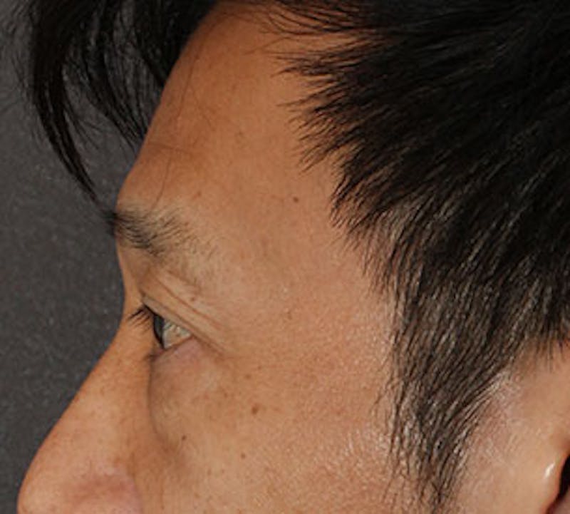 Blepharoplasty Before & After Gallery - Patient 12737125 - Image 9