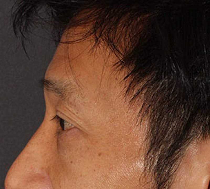 Blepharoplasty Before & After Gallery - Patient 12737125 - Image 10