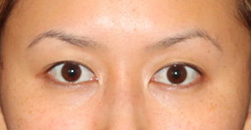 Asian (Double) Eyelid Before & After Gallery - Patient 12739651 - Image 1