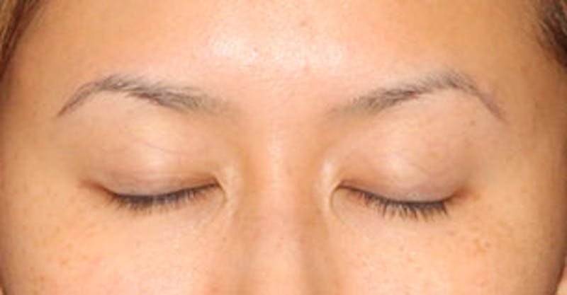 Asian (Double) Eyelid Before & After Gallery - Patient 12739651 - Image 3