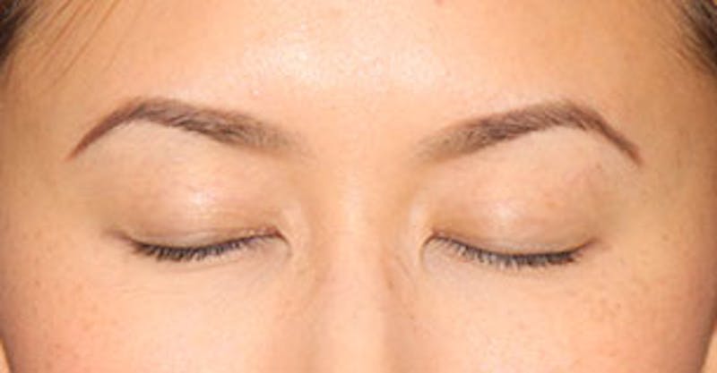 Asian (Double) Eyelid Before & After Gallery - Patient 12739651 - Image 4