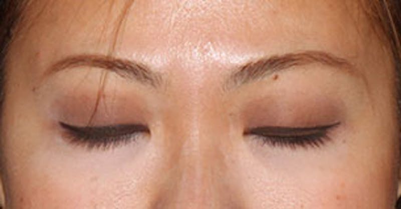 Asian (Double) Eyelid Before & After Gallery - Patient 12739652 - Image 3