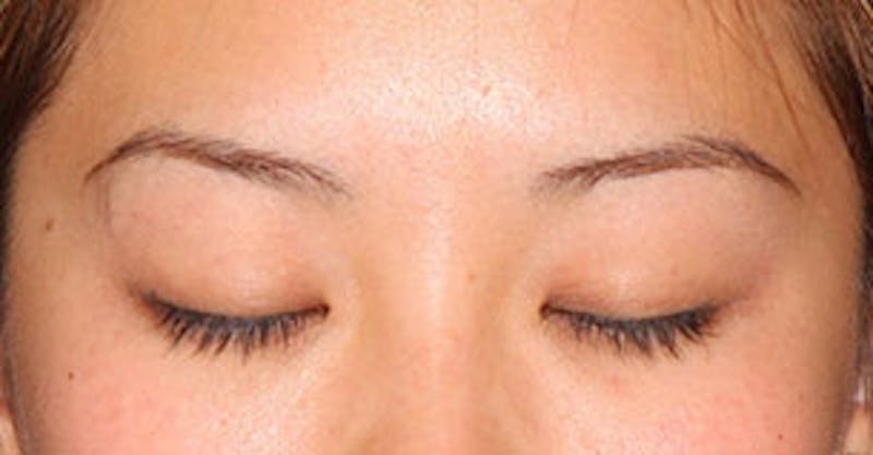 Asian (Double) Eyelid Before & After Gallery - Patient 12739654 - Image 3