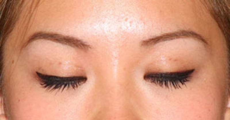 Asian (Double) Eyelid Before & After Gallery - Patient 12739654 - Image 4