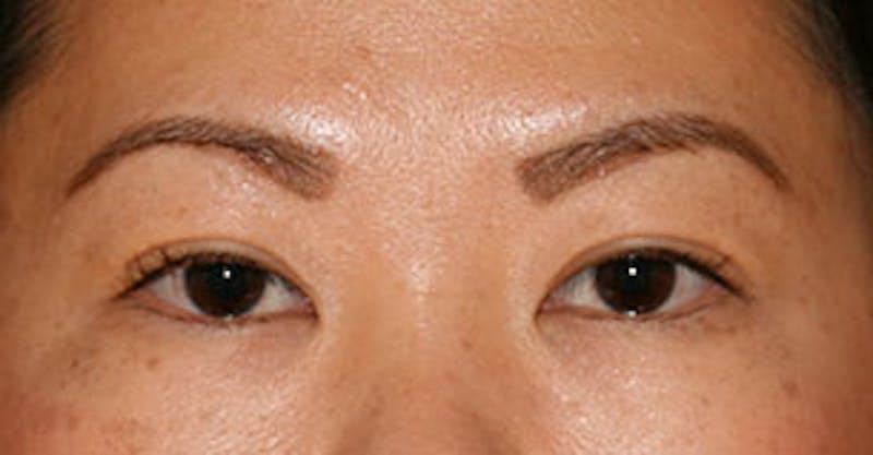 Asian (Double) Eyelid Before & After Gallery - Patient 12739656 - Image 2