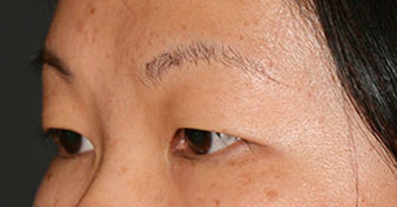 Asian (Double) Eyelid Gallery - Patient 12739656 - Image 5
