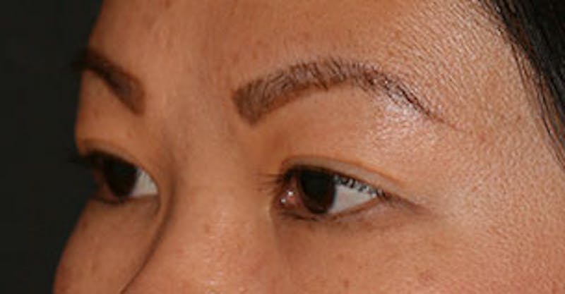 Asian (Double) Eyelid Before & After Gallery - Patient 12739656 - Image 6
