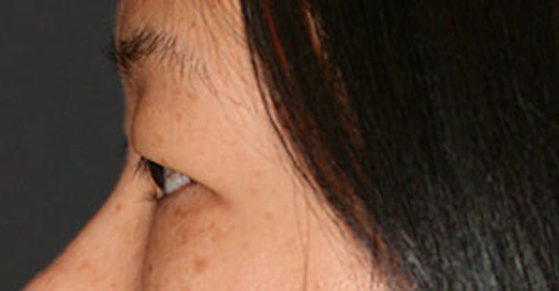 Asian (Double) Eyelid Gallery - Patient 12739656 - Image 9