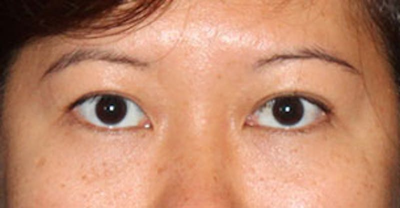 Asian (Double) Eyelid Before & After Gallery - Patient 12739661 - Image 1