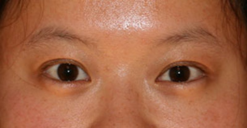 Asian (Double) Eyelid Before & After Gallery - Patient 12739666 - Image 2
