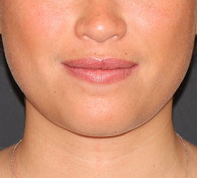 Neck Liposuction Before & After Gallery - Patient 12739671 - Image 2