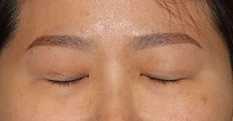 Asian (Double) Eyelid Before & After Gallery - Patient 12739670 - Image 4