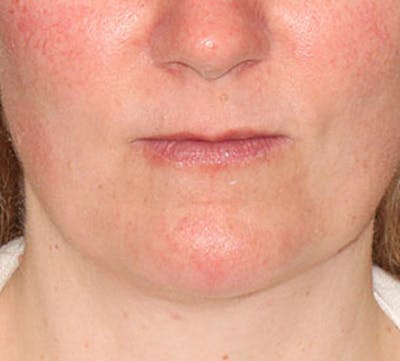 Neck Liposuction Before & After Gallery - Patient 12739678 - Image 2