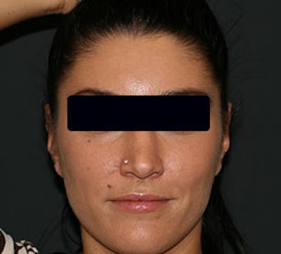 Otoplasty Before & After Gallery - Patient 12739675 - Image 2