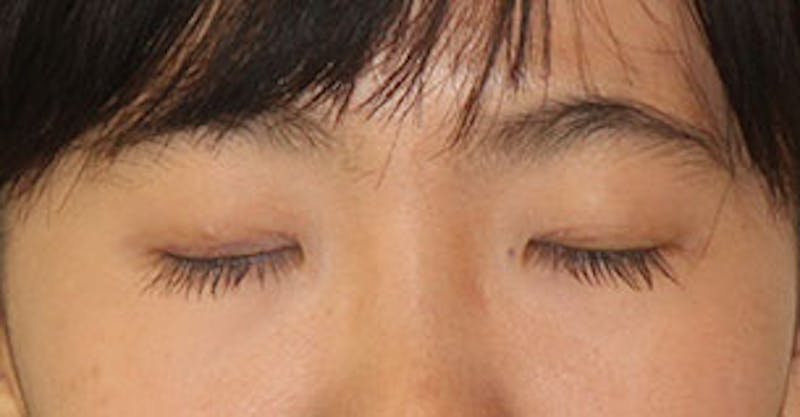Asian (Double) Eyelid Before & After Gallery - Patient 12739673 - Image 4