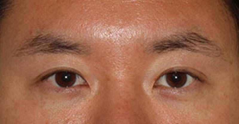 Asian (Double) Eyelid Before & After Gallery - Patient 12739681 - Image 2