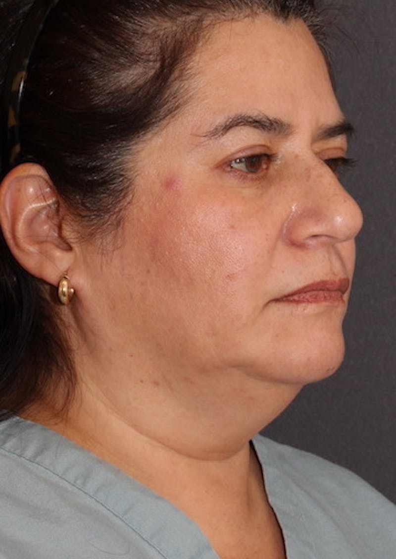 Facetite Before & After Gallery - Patient 12739682 - Image 3