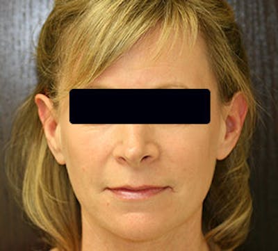 Otoplasty Before & After Gallery - Patient 12739677 - Image 1