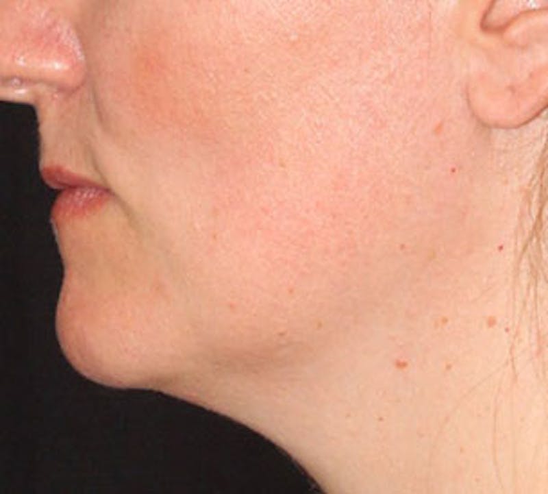 Neck Liposuction Before & After Gallery - Patient 12739678 - Image 9