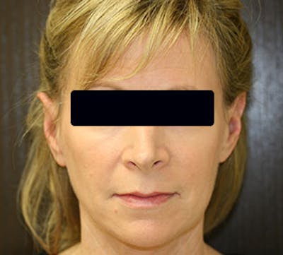 Otoplasty Before & After Gallery - Patient 12739677 - Image 2