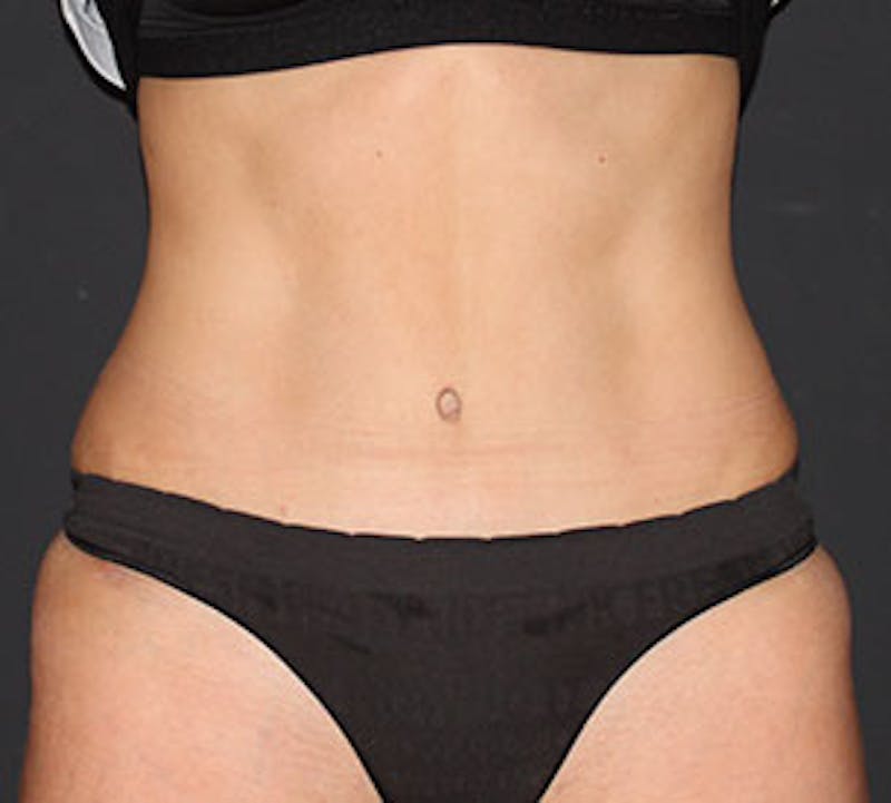 Tummy Tuck Before & After Gallery - Patient 12739685 - Image 2