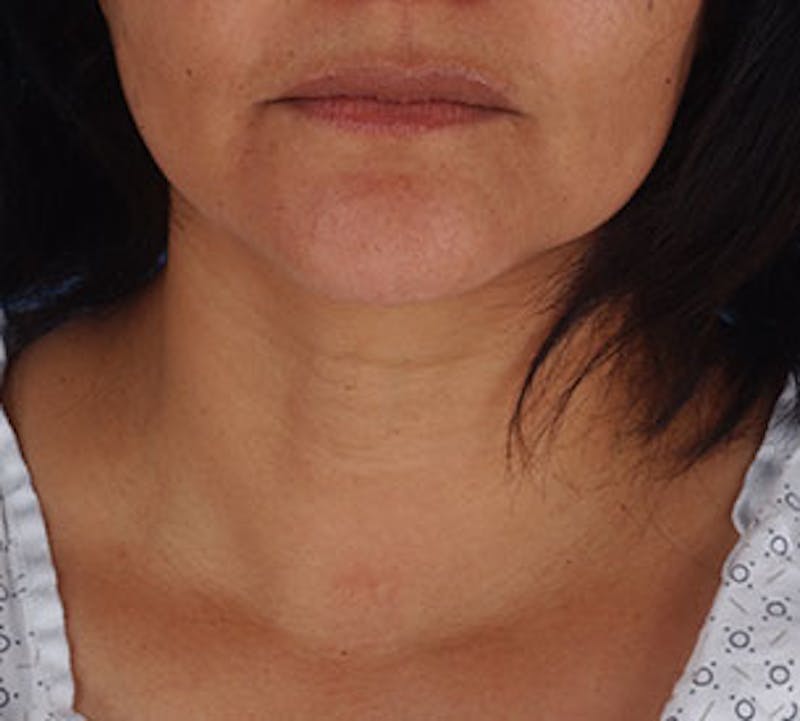 Neck Liposuction Before & After Gallery - Patient 12739689 - Image 2