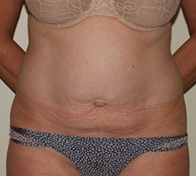 Tummy Tuck Before & After Gallery - Patient 12739695 - Image 1