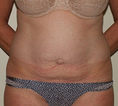 腹部整形手术前后画廊-病人12739695 -图片1