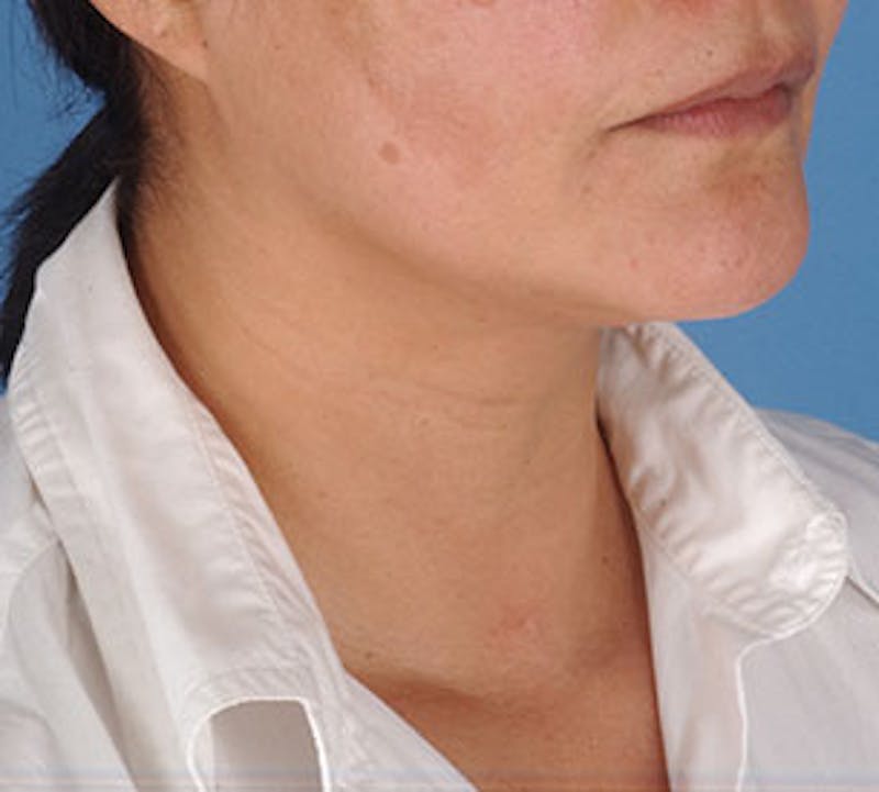 Neck Liposuction Before & After Gallery - Patient 12739689 - Image 3