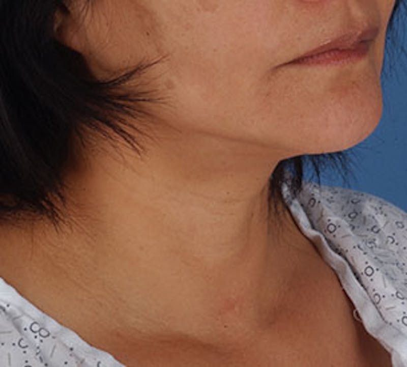 Neck Liposuction Before & After Gallery - Patient 12739689 - Image 4