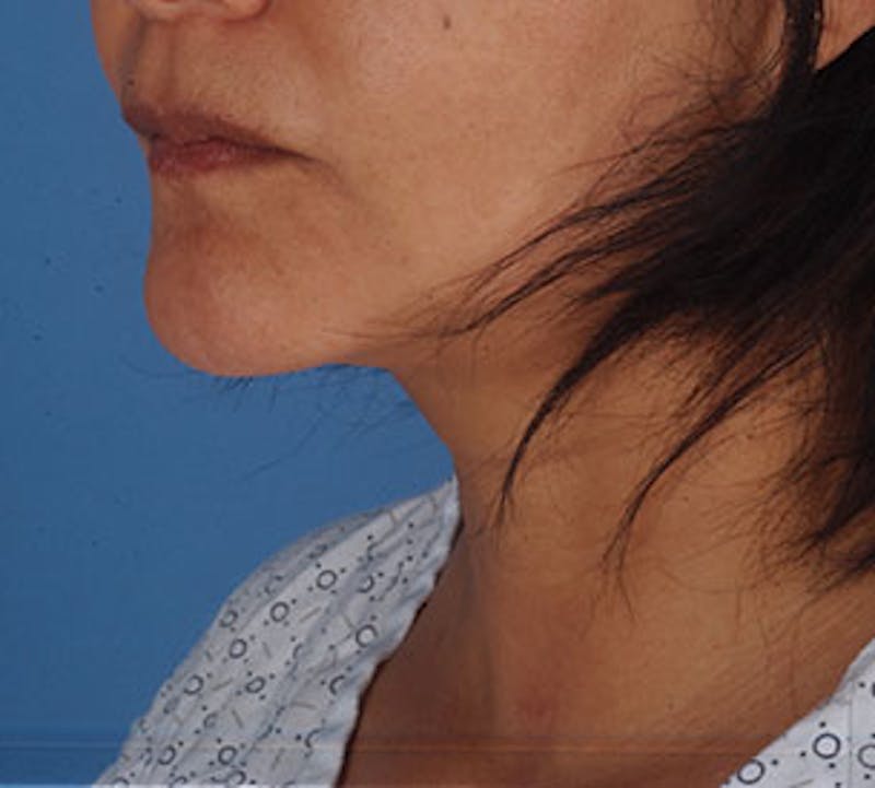 Neck Liposuction Before & After Gallery - Patient 12739689 - Image 6