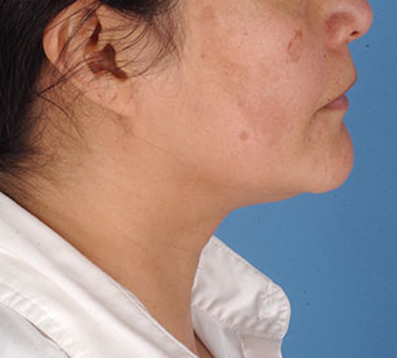 Neck Liposuction Before & After Gallery - Patient 12739689 - Image 7