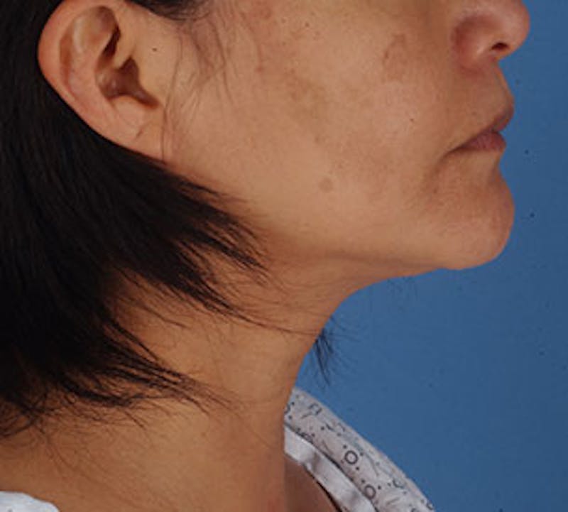 Neck Liposuction Before & After Gallery - Patient 12739689 - Image 8
