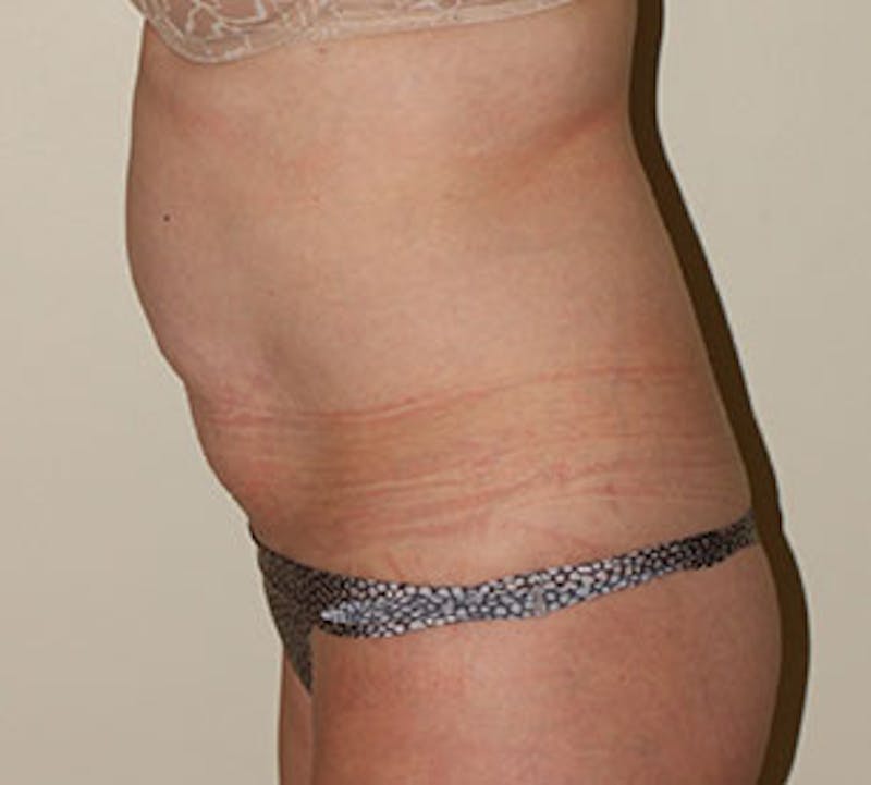 Tummy Tuck Before & After Gallery - Patient 12739695 - Image 9