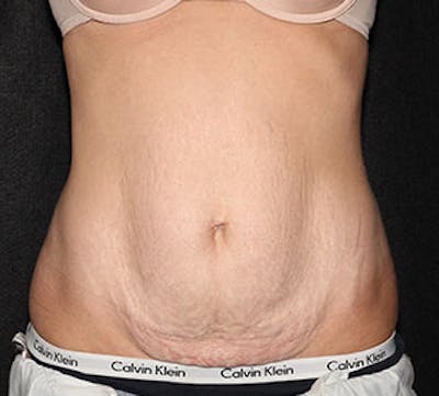 腹部整形手术前后画廊-病人12739705 -图片1