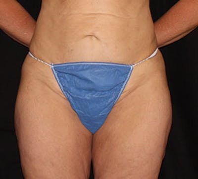 After Weight Loss Gallery - Patient 12740936 - Image 1