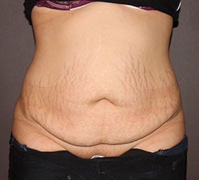 Tummy Tuck Before & After Gallery - Patient 12740932 - Image 1