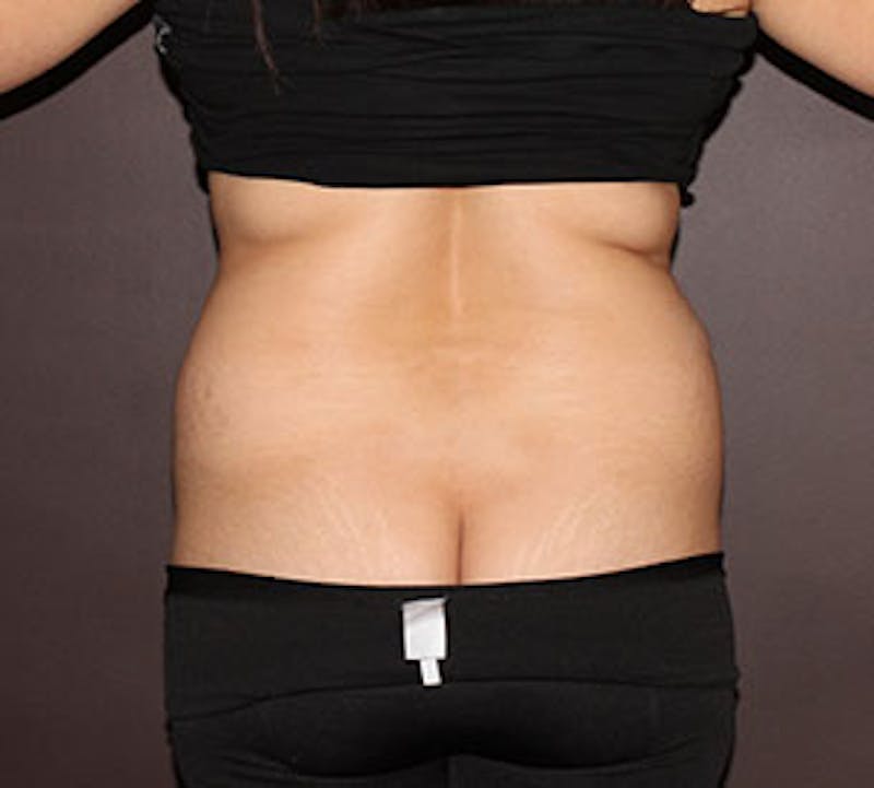 Liposuction Before & After Gallery - Patient 12740931 - Image 1