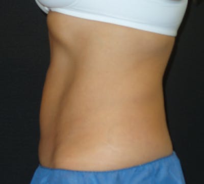 CoolSculpting Before & After Gallery - Patient 12740950 - Image 2