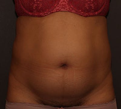 腹部整形手术前后画廊-病人12740951 -图片1