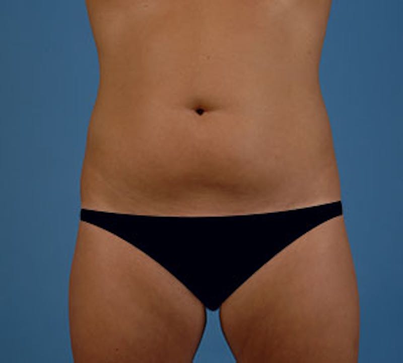 Liposuction Before & After Gallery - Patient 12740952 - Image 1