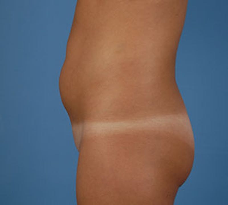 Liposuction Before & After Gallery - Patient 12740952 - Image 5