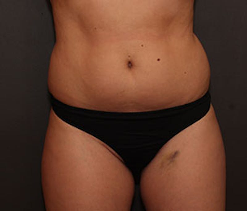 Brazilian Butt Lift Before & After Gallery - Patient 12740955 - Image 11